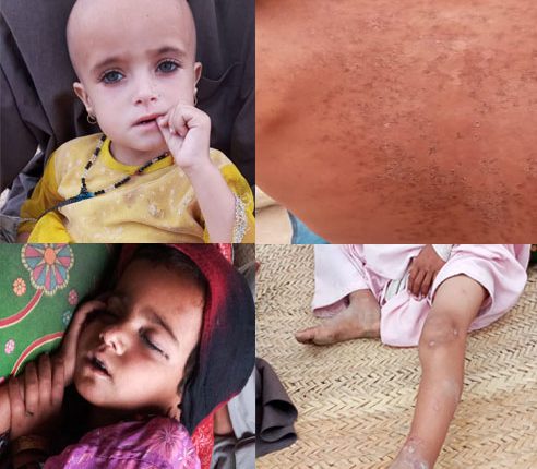 خضدار کی تحصیل وڈھ دراکھالی میں خسرے کی وباء سے دو بچے جاں بحق، درجنوں متاثر