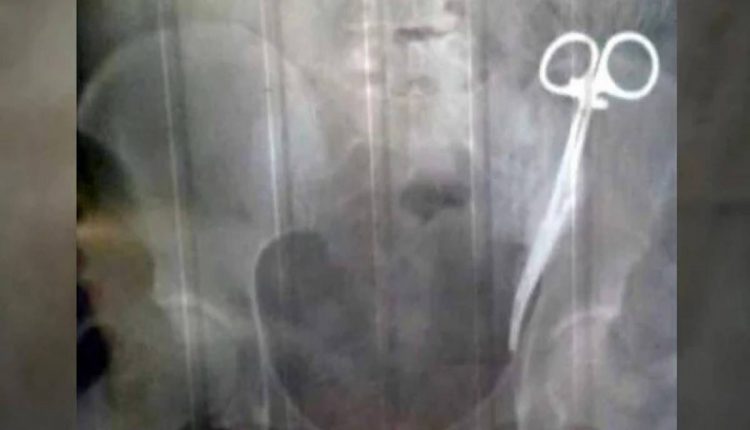 خاتون کے پیٹ سے 20 سال بعد قینچیاں نکال لی گئیں