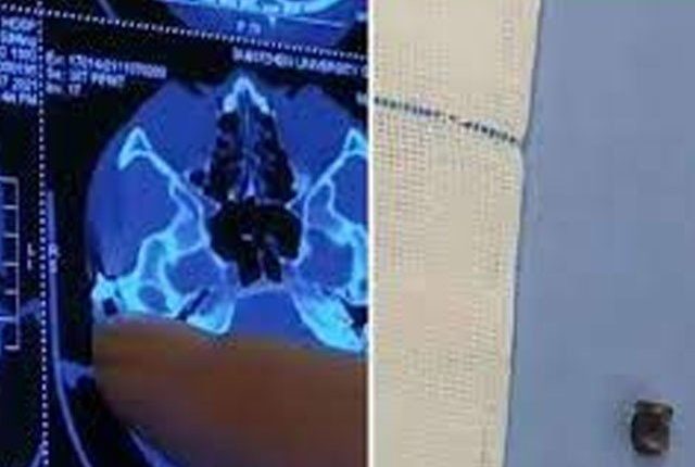 20 سال بعد ایک شخص کے سرسے گولی نکال دی گئی