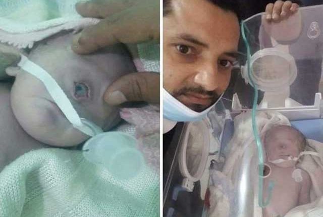 یمن میں ایک آنکھ والے بچے کی پیدائش
