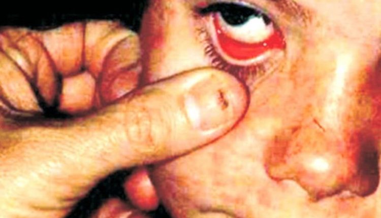 دالبندین میں خسرہ کی وباءپھیل گئی 2بچیاں جاں بحق