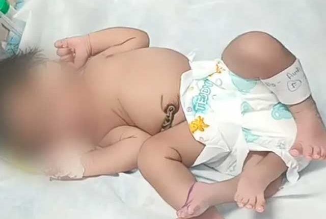بھارت میں چار ٹانگوں والی بچی کی پیدائش
